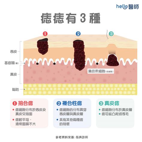 臉上長誌|痣變大、痣多或長毛會變皮膚癌？認識痣的形成與原因